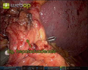 Pringle Maneuver Setup