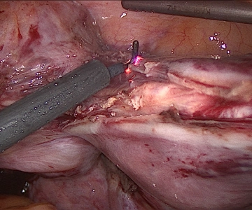 Separación del cuerpo uterino