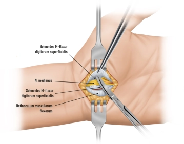Exposure and Inspection of Median Nerve and Flexor Tendons 1