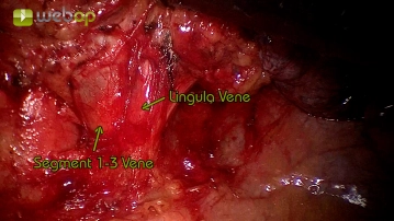 Preparation of the superior pulmonary vein