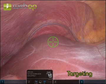 Pneumoperitoneum, Trocar Placement, and Docking 3