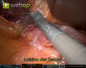 Serosal Incision at the Infundibulum