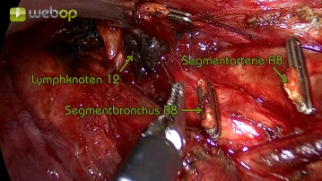Lymph node dissection station 12