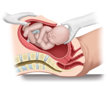 Child delivery/extraction 2