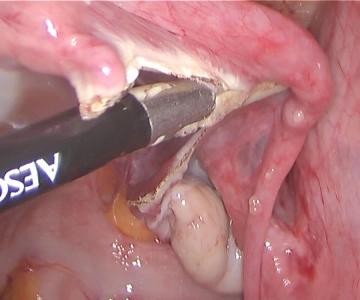 Left salpingectomy