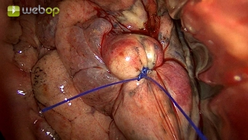 Identification and marking of the tumor