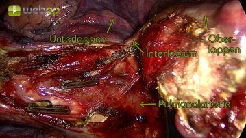 Preparation of the interlobar part of the pulmonary artery