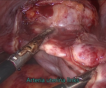Adnexectomía y aparato de soporte parametral izquierdo 1