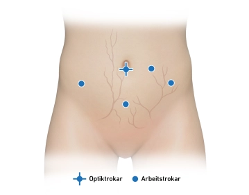 Working trocars and inspection of the pelvis 1