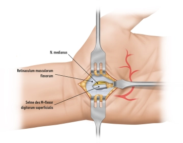 Transection of the Flexor Retinaculum 1