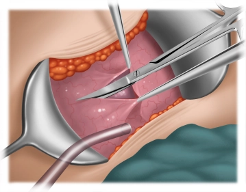 Preparation of the urinary bladder 2