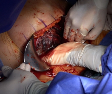 Child delivery/extraction 1