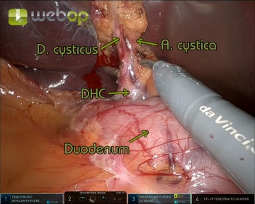 Dissection of Calot’s Triangle 1