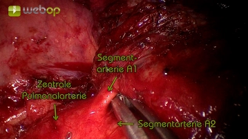 Dissection of the segmental arteries A1 to A3