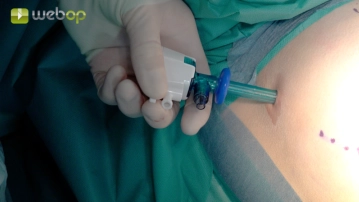 Insertion of the optical trocar