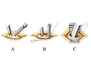 Mini-Laparotomie und Anlegen des Pneumoperitoneums