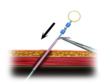 Implantation des Dialysekatheters