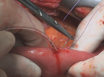 Intestinal catheter fixation