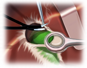 Cholecystectomy