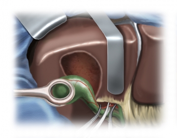 Cystic artery ligation