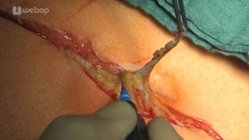 Scar excision