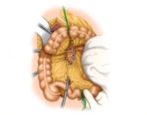 Selecting the intestinal loop