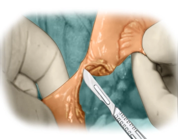 Resección del segmento intestinal