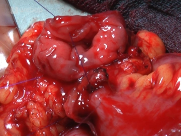 Sutura intestinal 1 (Colocación de los hilos de sujeción)