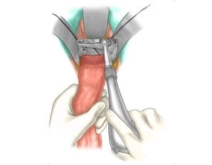 Resecting the rectum