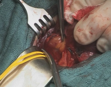 Resection of the superior right parathyroid