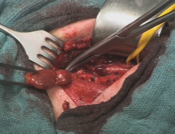 Starting the right transcervical thymectomy