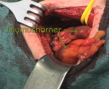 Thymectomy