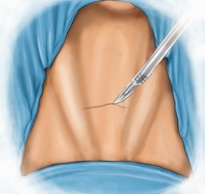 Kocher or collar incision