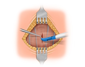 Midline division of the strap muscles