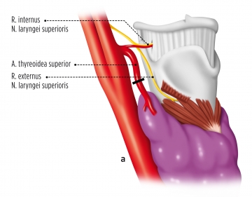 Freeing the right superior pole of the thyroid