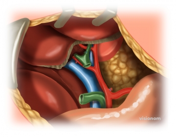 Exposing the CBD/CHD