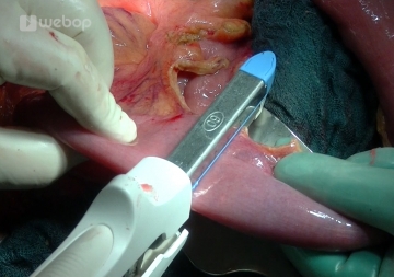 Dissecting the jejunal loop