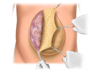 Opening of the Abdomen; Removal of Split-Thickness Skin