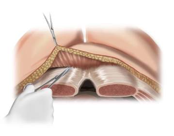 Presentation of the External Aponeurosis