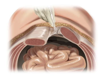 Incision of the Posterior Rectus Sheath