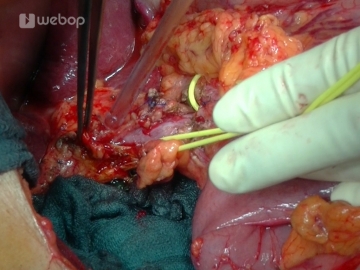 Transecting the common bile duct