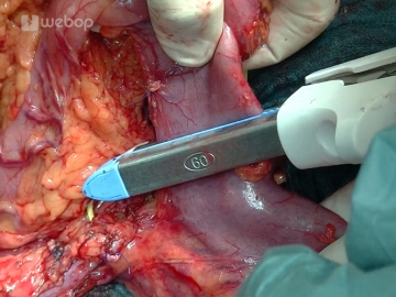 Transecting the postpyloric duodenum