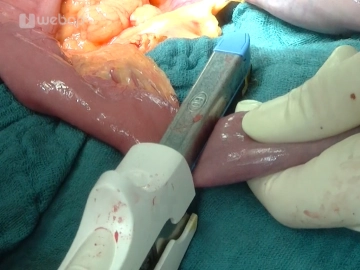 Transecting and skeletonizing the first jejunal loop