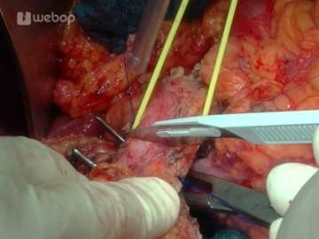 Transecting the jejunum