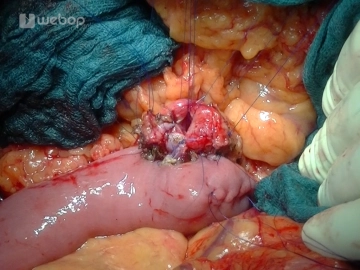 End-to-side retrocolic pancreatojejunostomy
