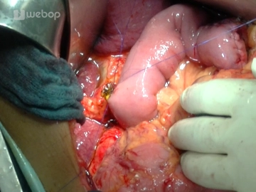 End-to-side hepaticojejunostomy