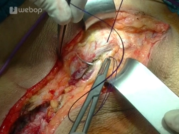 Closing the abdominal wall