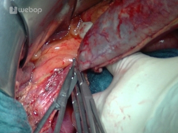 Antegrade cholecystectomy