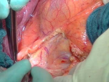 Mobilizing the hepatic flexure/Kocher maneuver