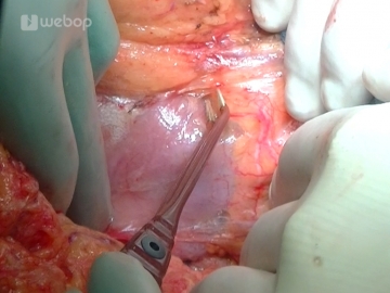 Exposing the inferior aspect of the pancreas and the mesenterico-portalvenous vascular axis